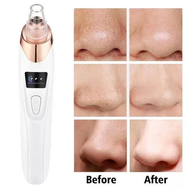 Upgraded Blackhead Remover Vacuum | Electric Facial Pore Cleaner